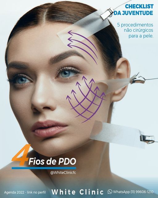 Fios-de-PDO.jpg