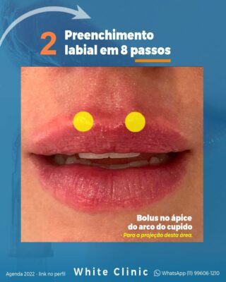 Preenchimento Labial em 8 passos