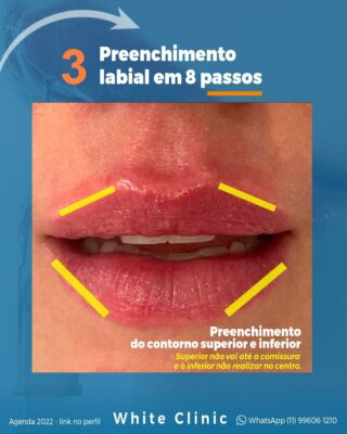 Preenchimento Labial em 8 passos