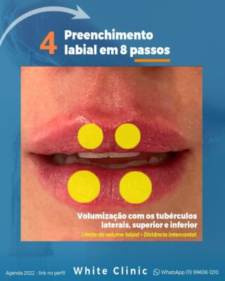 Preenchimento Labial em 8 passos