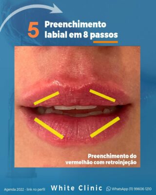 Preenchimento Labial em 8 passos