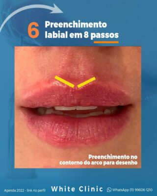 Preenchimento Labial em 8 passos