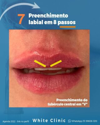 Preenchimento Labial em 8 passos