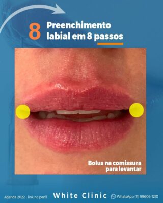 Preenchimento Labial em 8 passos